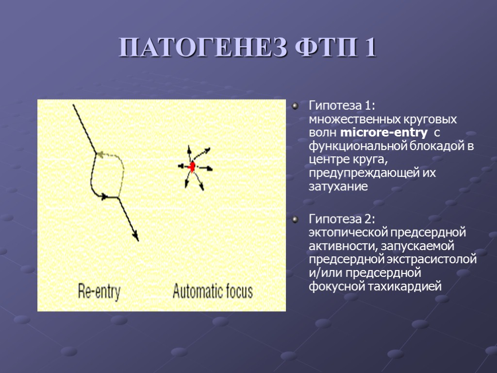 ПАТОГЕНЕЗ ФТП 1 Гипотеза 1: множественных круговых волн microre-entry c функциональной блокадой в центре